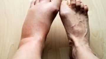 5 طرق فعالة يوميا لتقليل ومنع تورم الساقين 5 طرق فعالة يوميا لتقليل ومنع تورم الساقين