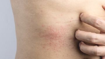 7 خطوات.. احمي الأماكن الحساسة من التهيج والعدوى في الصيف