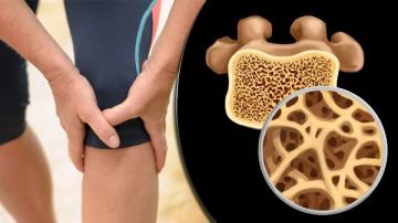 3 هرمونات قد تكون السبب وراء هشاشة العظام