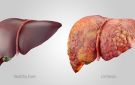 علاج الكبد الدهني بدون دايت.. اكتشاف علمي يغير قواعد العلاج