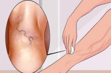 4 اعشاب لعلاج دوالى القدمين والساق