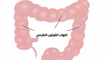 القولون التقرحي.. أنواعه وأسبابه تعرف عليها القولون التقرحي.. أنواعه وأسبابه تعرف عليها