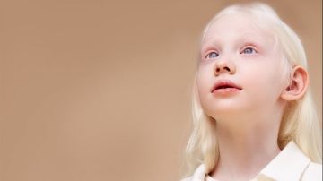في اليوم العالمي للمهق.. كل ما تود معرفته عن المرض في اليوم العالمي للمهق.. كل ما تود معرفته عن المرض