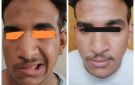 بعد جراحتين معقدتين.. فريق طبي بجامعة أسيوط يعيد وظائف العصب الوجهي لمريض بسرطان الغدة النكفية