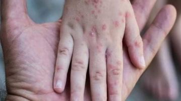 الأمم المتحدة تحذر من انتشار واسع وسريع لمرض جدري الماء في غزة الأمم المتحدة تحذر من انتشار واسع وسريع لمرض جدري الماء في غزة