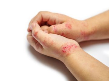 دون أدوية.. 3 طرق طبيعية وفعالة لعلاج الأكزيما دون أدوية.. 3 طرق طبيعية وفعالة لعلاج الأكزيما