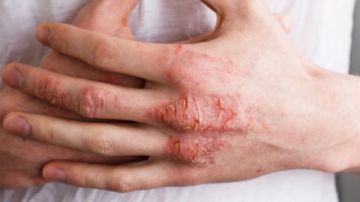 ماهى الصدفية وما أهم أعراضها ؟