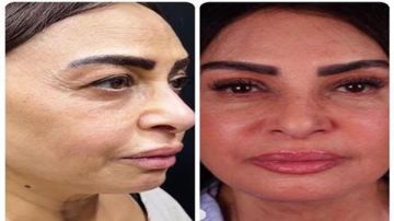 سلوي خطاب تثير الجدل بعد إجراء عملية تجميل بالوجه (صور) سلوي خطاب تثير الجدل بعد إجراء عملية تجميل بالوجه (صور)