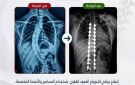 نجاح جديد في جراحات تشوهات العمود الفقري: طفلة عمرها 13 عاما.. تفاصيل 