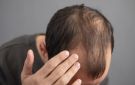 دواء لالتهاب المفاصل يساعد في علاج الثعلبة.. نتائج واعدة خلال 6 أشهر