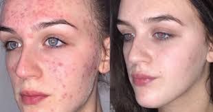 زيت غير متوقع يحارب البكتيريا وحب الشباب زيت غير متوقع يحارب البكتيريا وحب الشباب