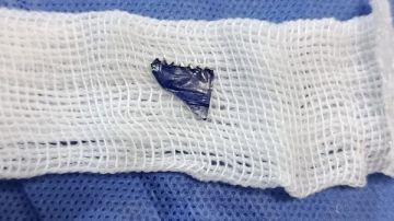 إنقاذ طفل من الاختناق بعد اكتشاف جزء من كيس مايونيز عالق بين الأحبال الصوتية بمستشفى أطفال بنها إنقاذ طفل من الاختناق بعد اكتشاف جزء من كيس مايونيز عالق بين الأحبال الصوتية بمستشفى أطفال بنها