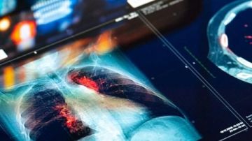 اختراق جديد في علاج سرطان الرئة.. لماذا يترقب الأطباء هذا الدواء؟ اختراق جديد في علاج سرطان الرئة.. لماذا يترقب الأطباء هذا الدواء؟