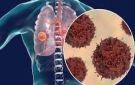 عشبة غير متوقعة تعالج أمراض الرئة والربو