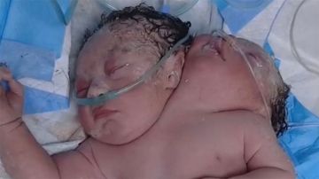 في مستشفى اليرموك.. ولادة نادرة لتوأم ملتصق بعملية قيصرية معقدة
