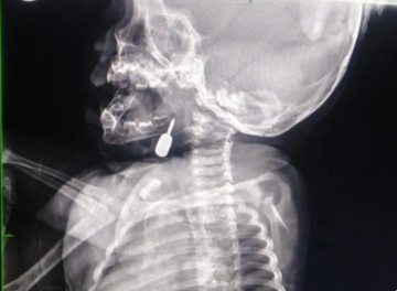 الأردن ... إنقاذ حياة طفل في مستشفى الملكة رانيا العبدالله الأردن ... إنقاذ حياة طفل في مستشفى الملكة رانيا العبدالله