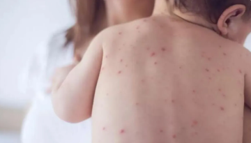 أعلى حصيلة منذ 30 عاما .. الحصبة تجتاح أمريكا أعلى حصيلة منذ 30 عاما .. الحصبة تجتاح أمريكا