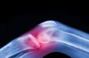 العلاج الأقوى لآلام المفاصل قبل اللجوء إلى الأدوية والجراحة العلاج الأقوى لآلام المفاصل قبل اللجوء إلى الأدوية والجراحة