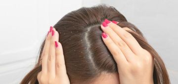 علاج القشرة بمكون طبيعي.. حل سحري لفروة الرأس علاج القشرة بمكون طبيعي.. حل سحري لفروة الرأس