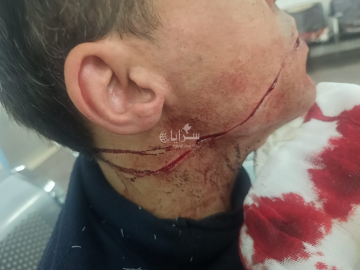 بـ22 غرزة في الوجه .. شاب يتعرض لاعتداء عنيف في بيادر وادي السير .. تفاصيل بـ22 غرزة في الوجه .. شاب يتعرض لاعتداء عنيف في بيادر وادي السير .. تفاصيل