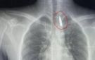 إنقاذ مصاب من غزة بعد استخراج مقذوف استقر في صدره - jo