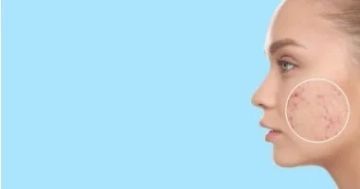 3 حيل بسيطة لتحسين مظهر حفر البشرة الناتجة عن حب الشباب