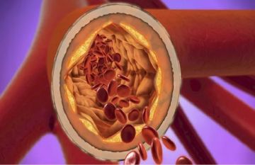 دواء جديد يخفض الكوليسترول الضار بنسبة قياسية