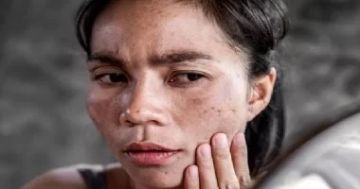 نادرة وتحدث بسبب التدفئة البسيطة.. ما هى متلازمة الجلد المحمص