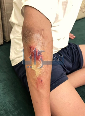 4 كلاب ضالة تهاجم طفلا في المفرق (صور)