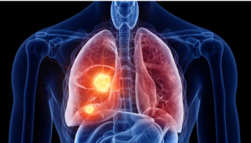 جهاز ثوري يكشف سرطان الرئة في مراحله الأولى عبر تحليل النفس