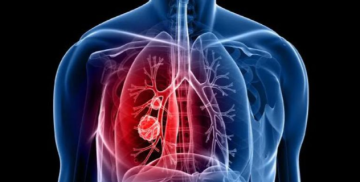 علماء يكتشفون المحرك الرئيسي لتطور سرطان الرئة في مراحله المبكرة