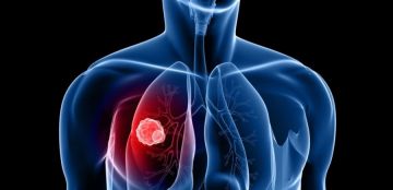 بشرى لمرضى السرطان: تقنية تعيد فعالية العلاج الكيميائي لأورام الرئة