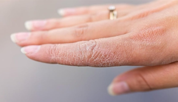 بشرتك تكشف الخطر .. علامات مبكرة للسكري تظهر على الجلد