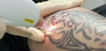 سرطان الجلد والوشم.. ما الذي تقوله الدراسات؟