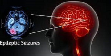 علاج غير جراحي يمنح الأمل في السيطرة الدقيقة على نوبات الصرع علاج غير جراحي يمنح الأمل في السيطرة الدقيقة على نوبات الصرع