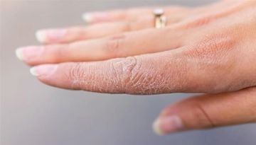 بشرتك تكشف الخطر.. علامات مبكرة للسكري تظهر على الجلد