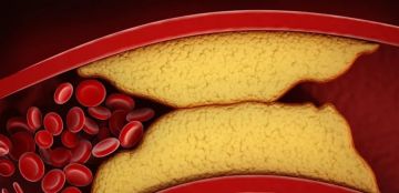 علاج جديد للكوليسترول الضار.. اليكم آخر ما اظهرته التجارب السريرية