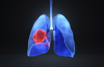 اكتشاف المحرك الرئيسي لتطور سرطان الرئة في مراحله المبكرة اكتشاف المحرك الرئيسي لتطور سرطان الرئة في مراحله المبكرة