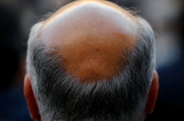 كيف تحمي فروة رأسك من الصلع الوراثي؟