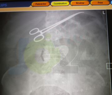 مقص جراحي منسي داخل بطن مريض في البشير.. لجنة تحقيق لكشف الملابسات عاجل