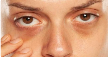 لكل منها دلالة .. ماذا تعني ألوان الهالات تحت العينين ؟