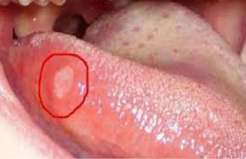 أعراض خفية للسرطان تظهر على اللسان