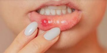 تقرحات الفم المتكررة قد تنذر بأمراض خطيرة