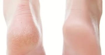 5 طرق طبيعية للتخلص من تشققات القدمين