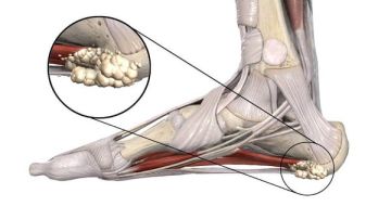 الشوكة العظمية .. كيف تكتشفها وتتعامل مع ألمها؟