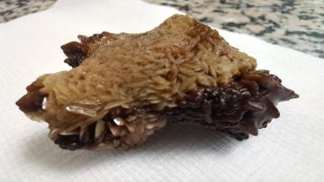 لأول مرة في الأردن .. عملية نوعية لاستخراج حصوة من الكلى باستخدام المنظار في مأدبا