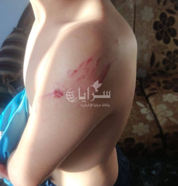 إصابة 3 أطفال بهجوم كلب ضال في إربد (صور)