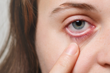 3 أسباب لحرقة العين وطرق بسيطة للتخلص من الانزعاج