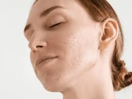 3 حيل بسيطة لتحسين مظهر حفر البشرة الناتجة عن حب الشباب