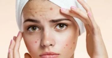 طرق طبيعية بسيطة للتخلص من حب الشباب.. أبرزها الليمون والعسل